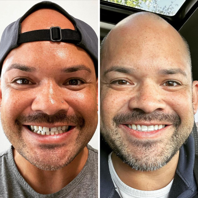 Invisalign® Before and After - Case 05