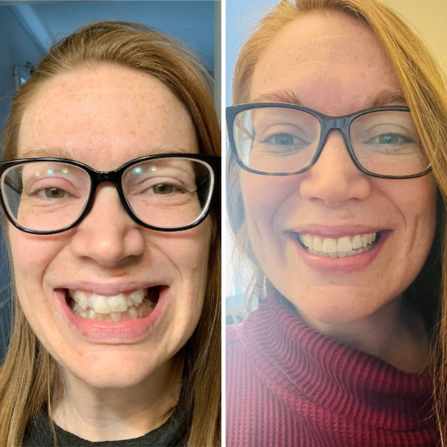 Invisalign® Before and After - Case 07