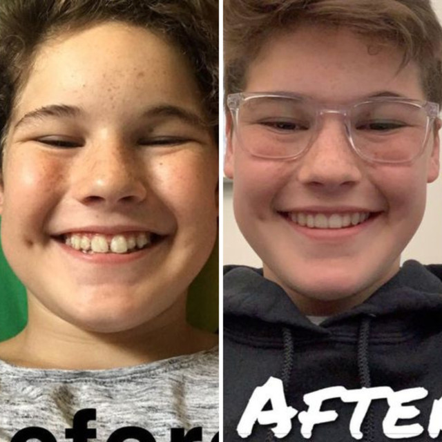 Invisalign® Before and After - Case 09