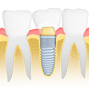 Implants—The New and Improved Tooth Fairy
