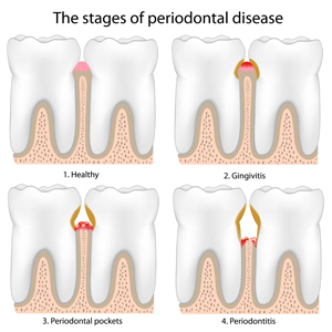 What to Know About Gum Disease